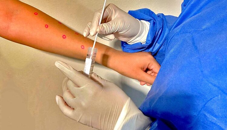 Médico realizando pruebas de viruela simica