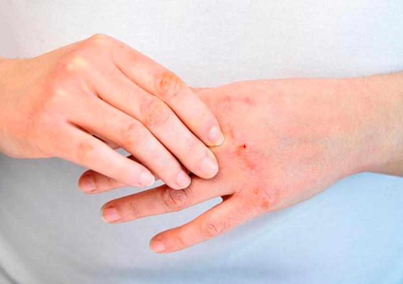 mano resecas piel reseca ¿Cómo evitar resequedad en la piel por uso de gel antibacterial?